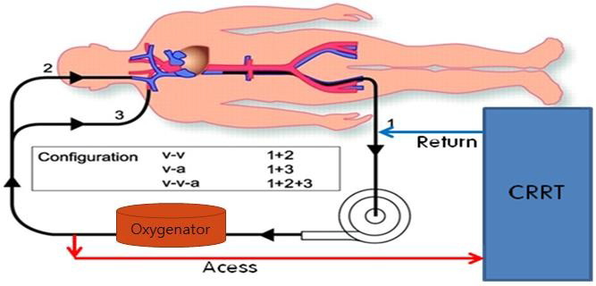 ECMO 간호 3 :: Ecmo 종류, Weaning, CRRT, setting, 모니터링, 알람 : 네이버 블로그