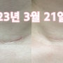 갑상선암수술후기 : 여포성종양진단~수술3개월 후