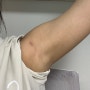 갑상선 항진증 전절제 로봇 수술 직후~1개월차 후기