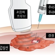 초음파 유도하 갑상선 세침흡인검사 [부산 사하구 하단][건강검진][삼성내과엠알영상의학과]