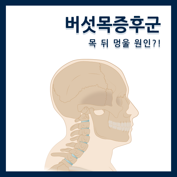 버섯목증후군, 목 뒤 멍울 원인?! 치료방법은? : 네이버 블로그
