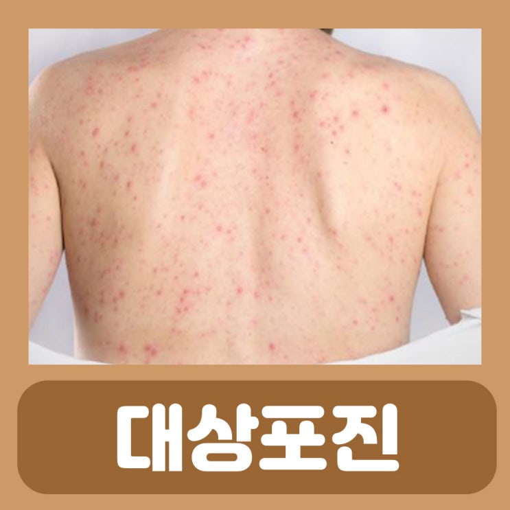 대상포진 치료 약 초기증상 눈 엉덩이 얼굴 대상포진 증상 원인 전염성 예방접종 백신 얼굴 피부 물집 : 네이버 블로그