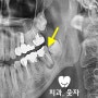 어금니크라운 교체시 사랑니발치를 고려하는 이유