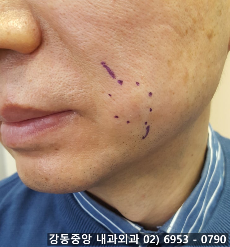 표피낭종 핀홀법 제거 수술 흉터 어느정도 남나요? (천보성 외과) : 네이버 블로그 표피낭종 핀홀법 제거 수술 흉터 어느정도 남나요? (천보성 외과) : 네이버 블로그