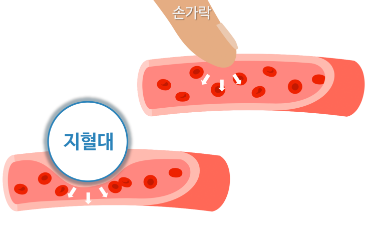 올바른 투석혈관 지혈방법 : 네이버 블로그