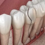 어금니깨짐 앞니 치아파절 치통 증상 치과치료