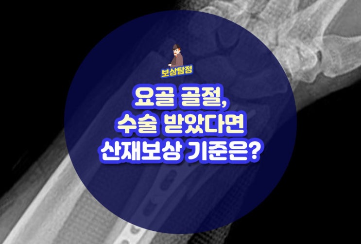 요골 골절, 수술 받았다면 산재보상 기준은? : 네이버 블로그