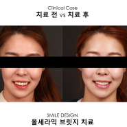 앞니 재치료 증례들을 보여드립니다