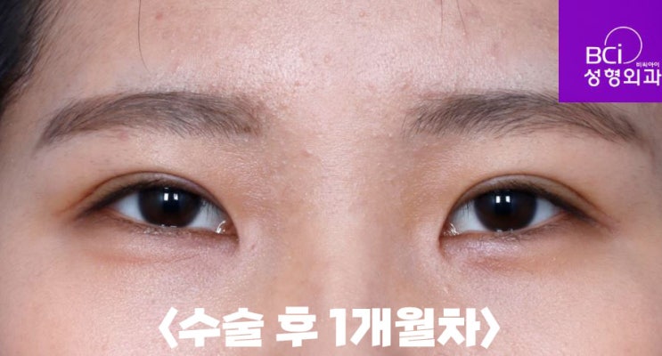 쌍꺼풀수술전후 고민을 해결해 보자! : 네이버 블로그