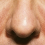 지루성 피부염 기본정보::정의 원인 증상...Arnuf 염증성 피부질환 얼굴 두피 코 입 턱 목