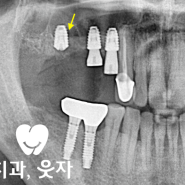 임플란트 후 흡연 그 결과는 실패