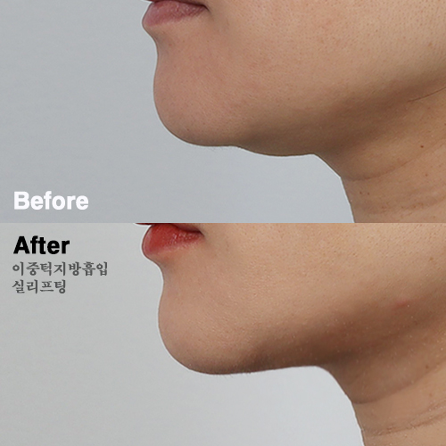 이중턱지방흡입 후, 턱살 해결!(강남성형외과 치유 실리프팅) : 네이버 블로그