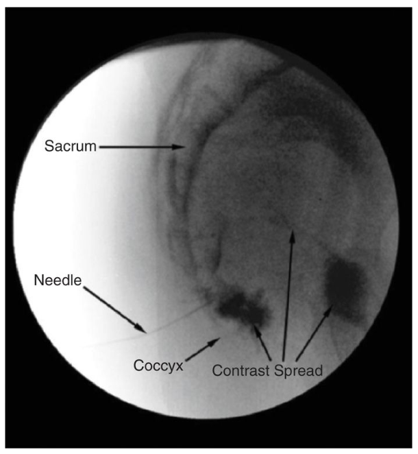 LA353 미골신경차단술 (Coccygeal Nerve block) 심의사례 및 적응증, 실시방법 : 네이버 블로그