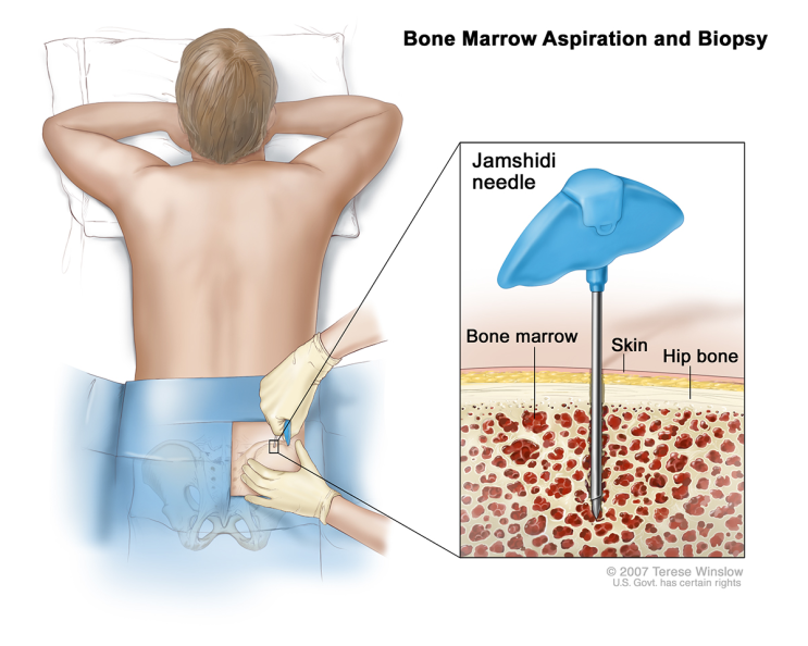 Knee-BMAC/ PSIS bone marrow harvest #골수줄기세포주사 #BMAC #stem cell #신의료기술 ...