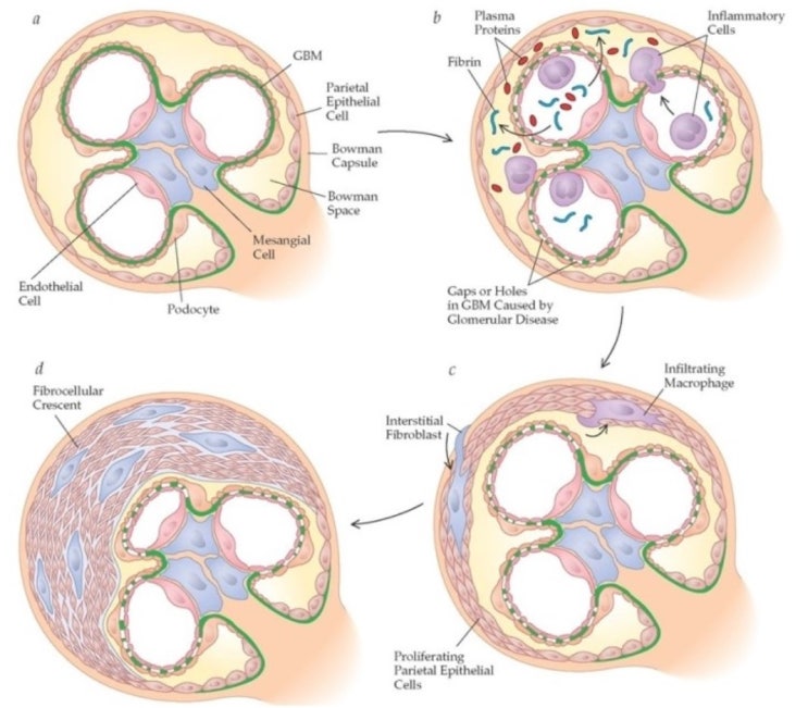 급속진행토리콩팥염 (RPGN : Rapidly progressive glomerulonephritis) : 네이버 블로그
