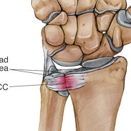 [힐트레이저]- 척골충돌증후군 손목 (TFCC)