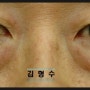 FAQ) 나이가 많으면 레이저눈밑지방재배치 보다는 피부절개를 통한 하안검 수술이 좋다는데 맞나요?