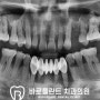 심한 염증으로 뼈까지 녹았다면 골이식과 함께 임플란트 수술 로 치아 기능을 회복할 수 있습니다. - 구리 치과 흔들리는 앞니 개선 사례