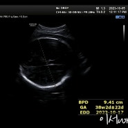 임신 37주, 태반 석회화 노화로 유도분만 날짜잡기 태아 몸무게 크기