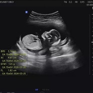 [12주 ~15주] 1,2차 기형아 검사, 초기 입체 초음파, 니프티
