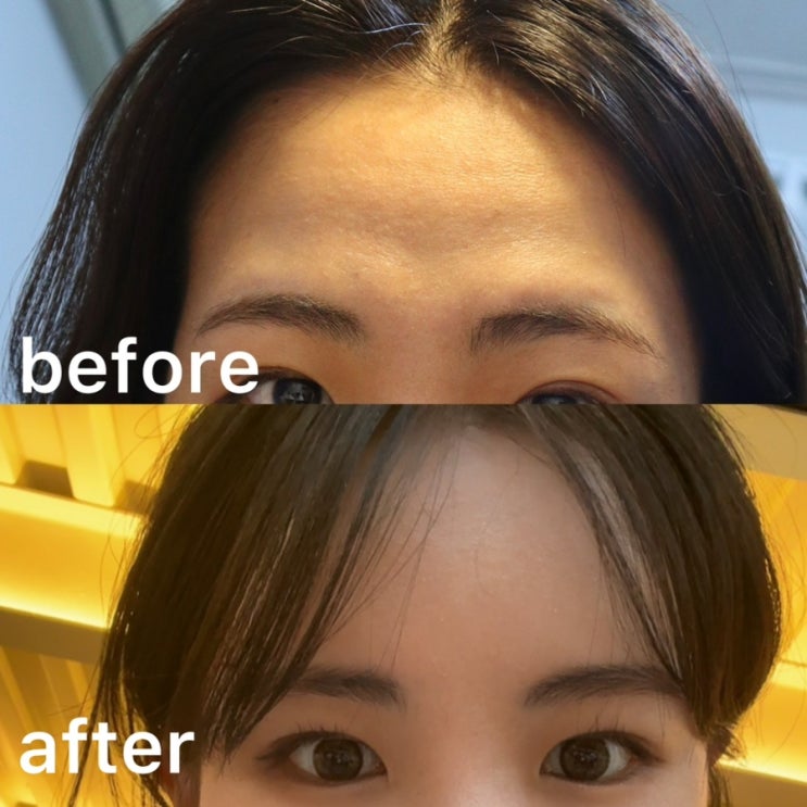이마필러 내돈내산 5개월 경과 함몰이마 이마보톡스 꼭 맞아야하는 이유 이마로 눈뜨는 습관 : 네이버 블로그 이마필러 내돈내산 5개월 경과 함몰이마 이마보톡스 꼭 맞아야하는 이유 이마로 눈뜨는 습관 : 네이버 블로그