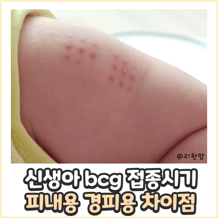 bcg접종시기 bcg종류 bcg접종열 주의사항, 경피용 피내용 장단점 비씨지 접종 주사 총정리 : 네이버 블로그