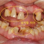 [전악 임플란트]전체 치아를 회복하는데 필요한 임플란트 개수는 몇 개일까요?
