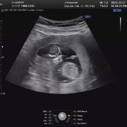 11주 6일 쌍둥이 기형아검사(니프티)