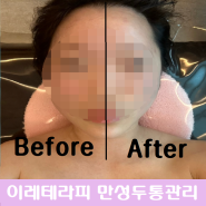 안양 평촌 이레테라피 만성두통관리 후기! 두통 없애는법, 얼굴 리프팅 (비포애프터 사진)