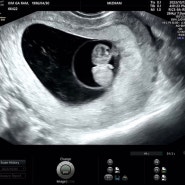 [임신일기] 임신 8-11주차 증상 기록✏ | 젤리곰에서 사람으로 | 입덧은 여전히..| 태아보험 자동차보험 특약 | 초음파 건강보험 횟수