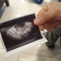 [5주~8주1일]아기집 확인, 임신확인서, 심장소리, 입덧 시작, 피비침