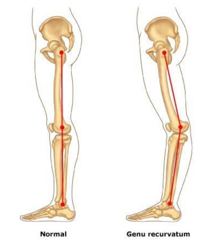 울산 필라테스 무릎이 아파요 back knee/genu recurvatum/반장슬/전반슬/knee hyperextension ...