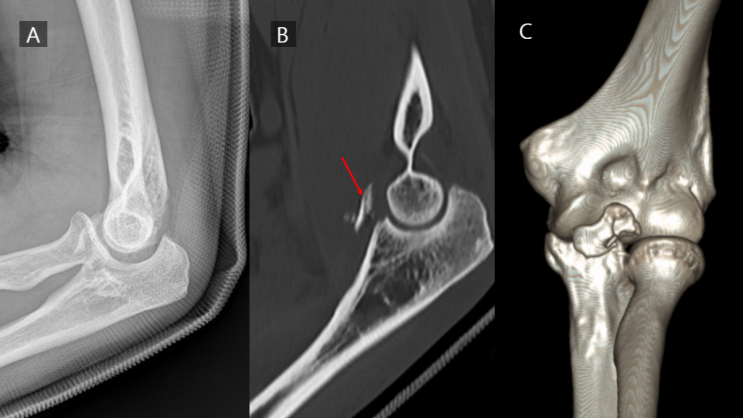 팔꿈치 외상 후 후외방 회전 불안정성 (PLRI, posterolateral rotatory instability), 어떤 ...