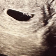 임신 5주차, 초음파로 아기집, 난황, 심장소리까지 확인하기