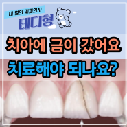 치아 금감 크랙 종류별로 증상 및 치료하는 방법