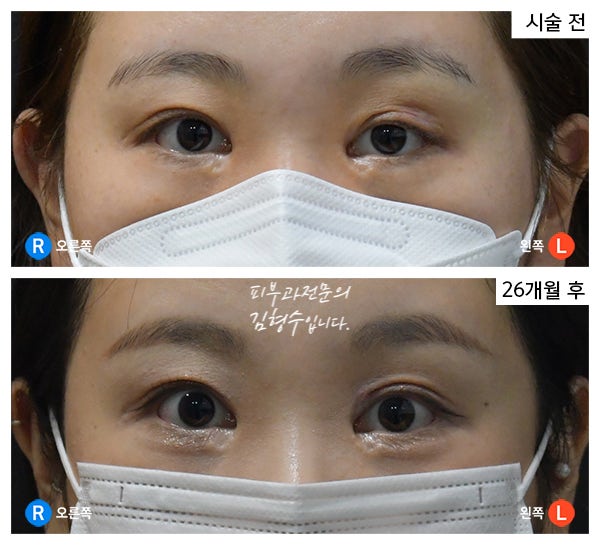 쌍꺼풀 수술 후 발생한 유착과 꺼짐에 대한 눈꺼풀 필러 : 네이버 블로그