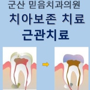 군산 미장동 치과 - 치아 보존치료(근관치료)