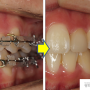 왜소치의 앞니 보철치료 - 광화문연치과