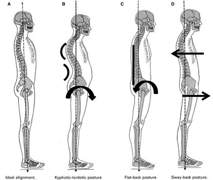 도마동 필라테스 Sway Back Posture 스웨이백(굽은등 자세) : 네이버 블로그
