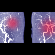 뇌경색 뇌출혈 : 신호를 읽어라 - 전조증상과 치료방법 및 예방법