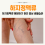 하지정맥류 예방하기 원인 증상 생활습관 알아봐요