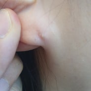 귀에생긴 몽우리 표피낭종 제거수술후기