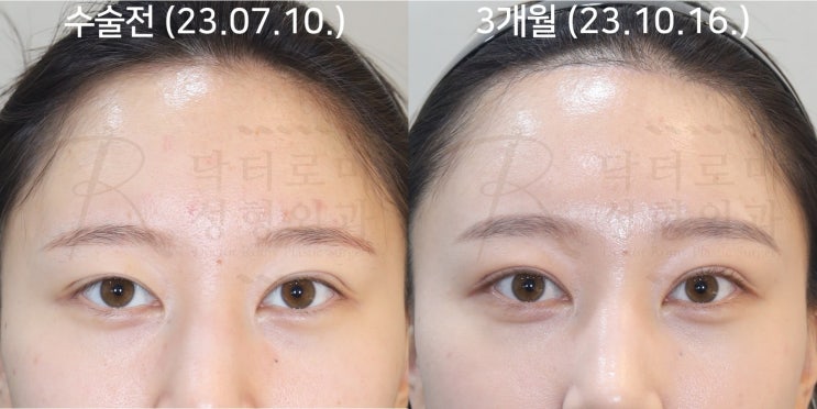 쌍꺼풀 높이기 재수술로 인해 발생한 쌍꺼풀 비대칭 재수술. 이마 눈썹 거상술이 필요한 이유. : 네이버 블로그
