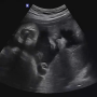 임신 35주 6일 막달검사 비용 및 절차, 압박 스타킹 의료보험 적용 처방(송파 고은빛산부인과)