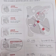 발작성 상심실성 빈맥 (PSVT)