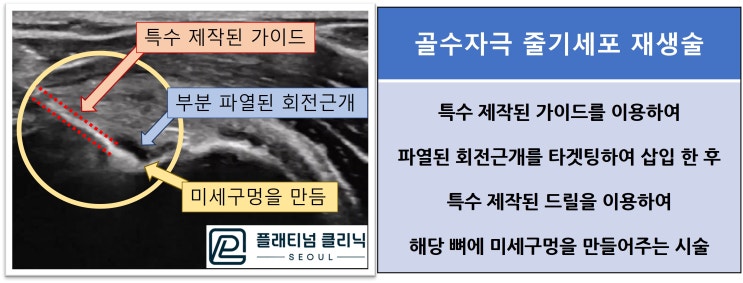 (플래티넘의원) 어깨 회전근개파열. 비수술적 치료로 나을 수 있을까?