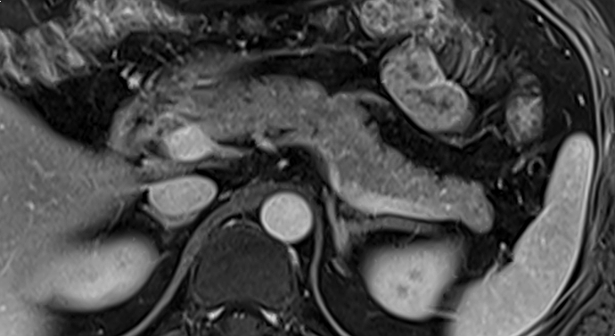췌장낭종 검사주기 / MRI, CT, EUS : 네이버 블로그