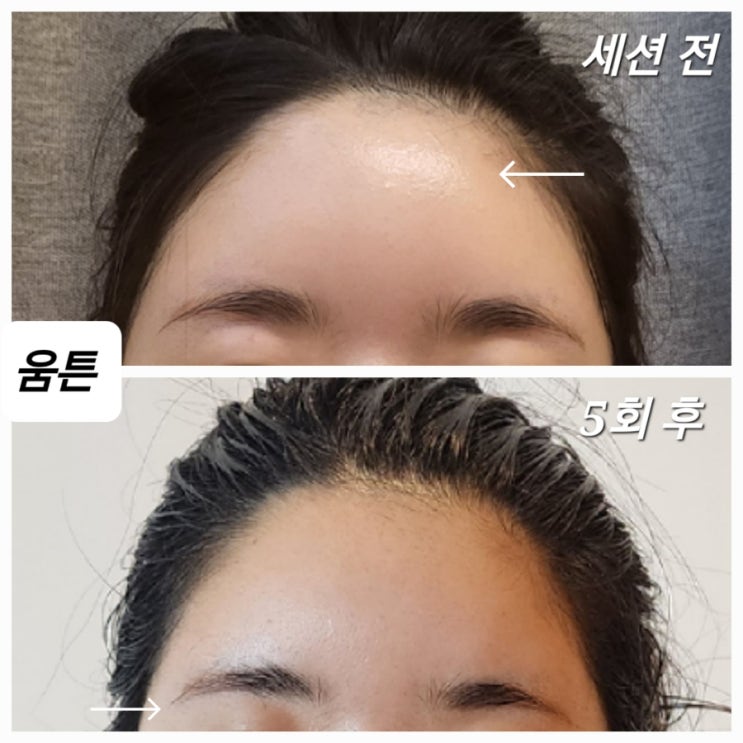 이마거상, 이마지방 이식 후 눈 붓기, 부종, 유착, 울퉁불퉁 부작용 : 네이버 블로그 이마거상, 이마지방 이식 후 눈 붓기, 부종, 유착, 울퉁불퉁 부작용 : 네이버 블로그