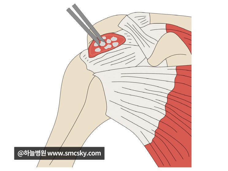 어깨 석회성건염(석회화건염) 증상 및 비수술 치료, 시술 병원 : 네이버 블로그