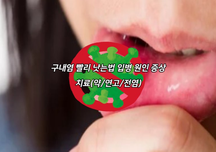 구내염 빨리 낫는법 입병 원인 증상 치료(약/연고/전염) : 네이버 블로그